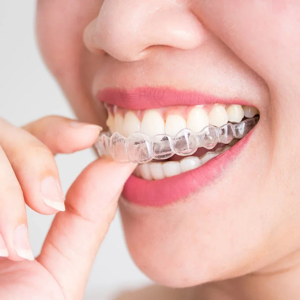Dental Guard Night - 1-4個入りいびき防止歯ぎしり防止睡眠用マウスガードトレイ、歯ぎしり防止睡眠補助ナイトガード、歯茎保護マウスヘルスケアツール