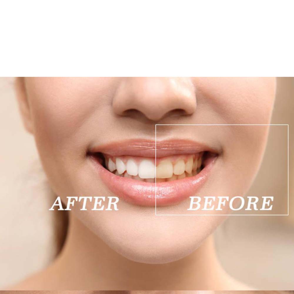 歯のホワイトニングキット,高品質の製品,過酸化物,明るい白, - Teeth Whitening Gels のレビューと価格